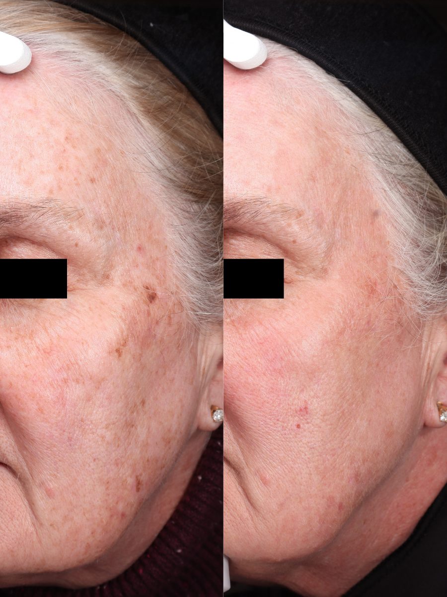 Best IPL Photofacial Atlanta & Sandy Springs, GA