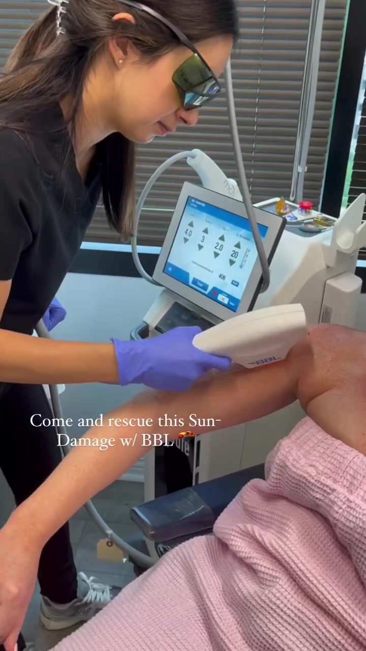 Sciton BBL broadband-light treatment on a client’s arm for visible sun damage at ELLEMES Medical Spa in Atlanta