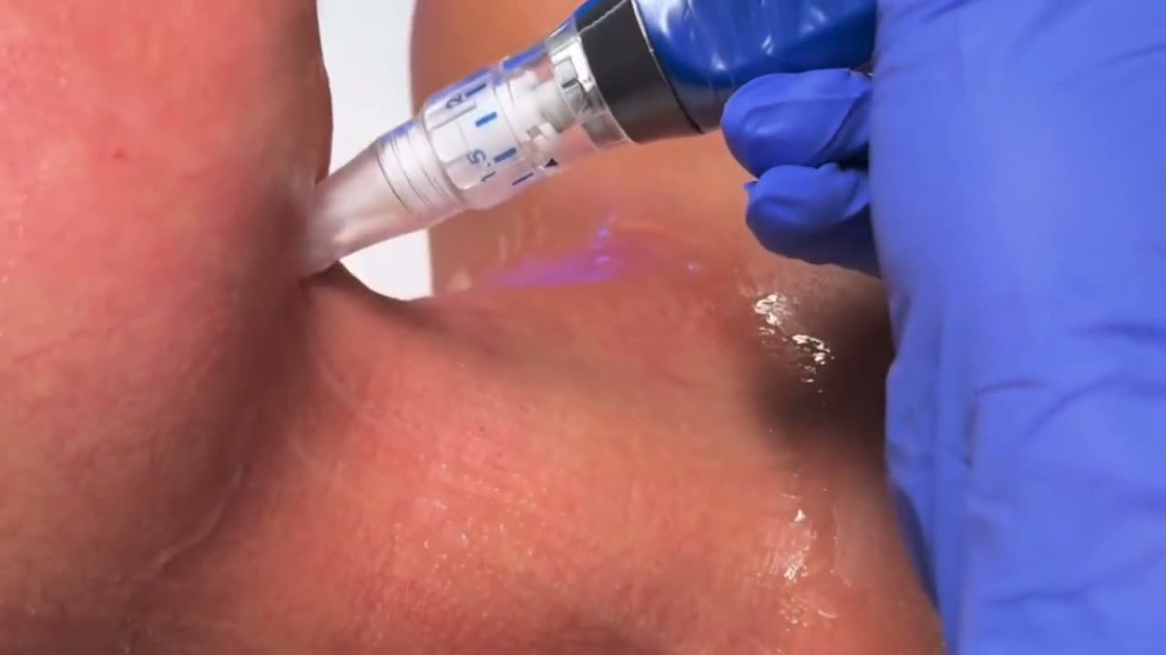 Microneedling treatment at ELLEMES Medical Spa