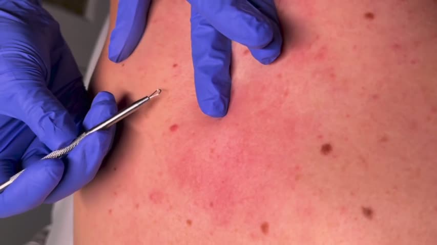 Back facial treatment at ELLEMES Medical Spa